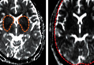 Transient oxygen deprivation is seen in the basal ganglia part of the brain in adults with non-fatal cerebral malaria (darker areas highlighted, left). The authors showed for the first time that fatal cerebral malaria in adults is associated with a profound lack of oxygen seen in the whole brain (dark areas throughout the organ, right). Credit:https://doi.org/10.1093/cid/ciaa1647 - Clinical Infectious Diseases 