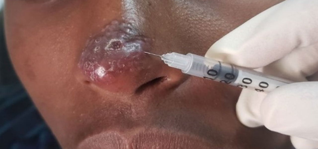 Patient receiving intra-lesion therapy. Credit: WHO Regional office for Africa image.