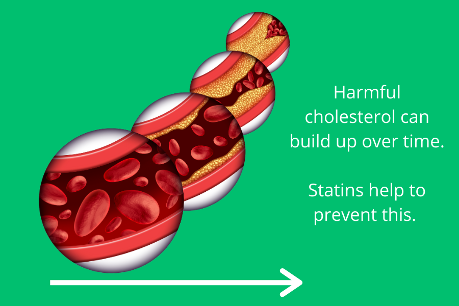 Four circles showing cartoon blood vessels and in each one (left to right), yellow cholesterol begins to building up on the walls and block the vessel. Caption says 'Harmful cholesterol can build up over time. Statins help to prevent this.'  