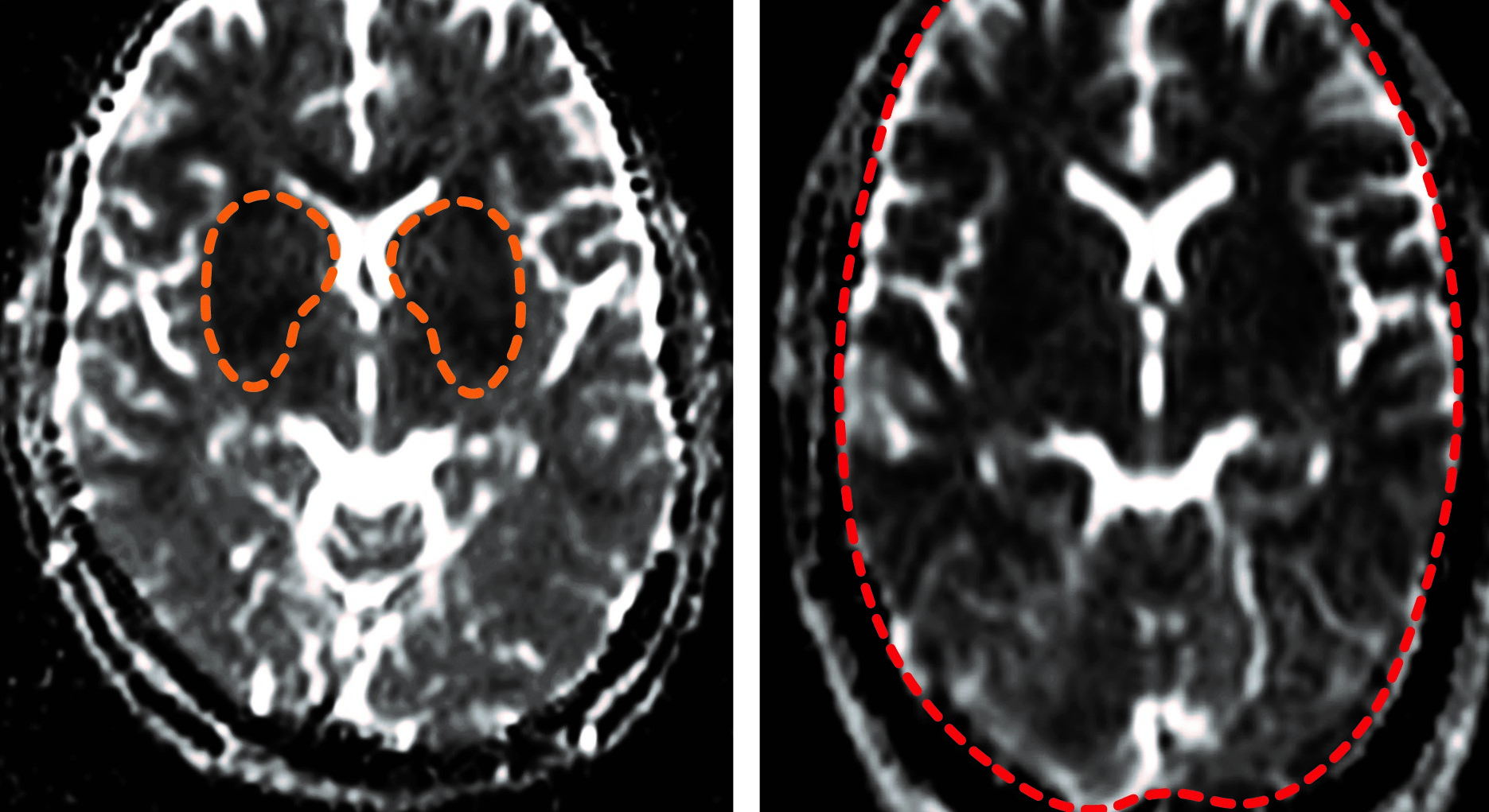Transient oxygen deprivation is seen in the basal ganglia part of the brain in adults with non-fatal cerebral malaria (darker areas highlighted, left). The authors showed for the first time that fatal cerebral malaria in adults is associated with a profound lack of oxygen seen in the whole brain (dark areas throughout the organ, right). Credit:https://doi.org/10.1093/cid/ciaa1647 - Clinical Infectious Diseases 