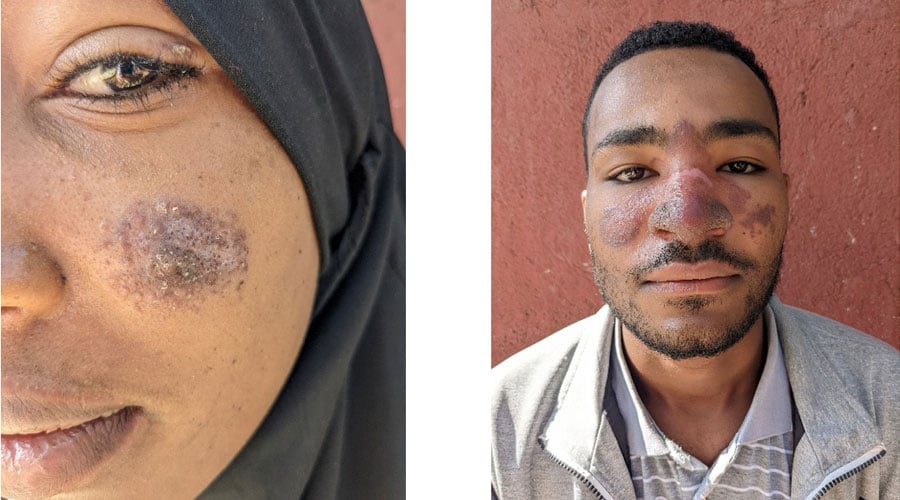 Left: Young woman with a localised CL lesion on the cheek, Ethiopia, and, right: Young man with mucocutaneous CL affecting the nose, Ethiopia