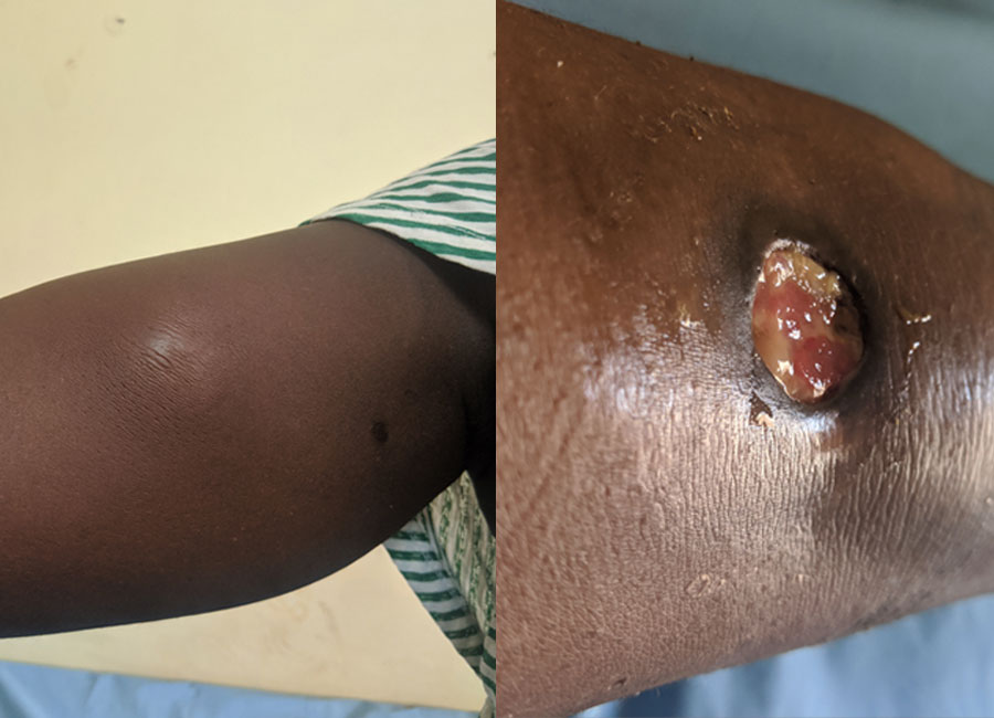 Patients with early Buruli ulcer