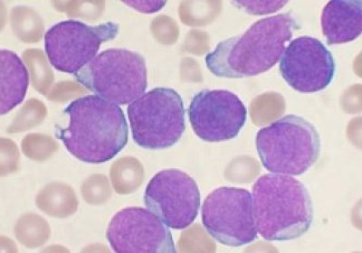 A Wright&#039;s stained bone marrow aspirate smear of patient with precursor B-cell acute lymphoblastic leukemia