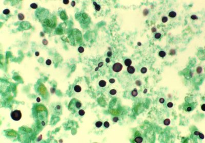 Caption: Lung tissue specimen from AIDS patient with cryptococcosis. Caption: CDC Public Health Image Library