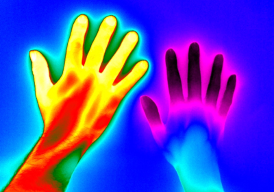 Thermogram of two hands. Hand on the right has Raynaud’s syndrome, appearing purple and blue instead of yellow and red.