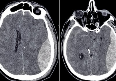 CT scan showing enlarging epidural