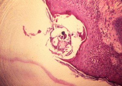 Caption: Photomicrograph of scabies burrowed into skin tissue Credit CDC Public Health Image Library