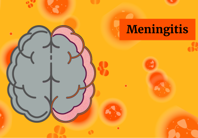 A graphic representing meningitis (inflammation of membranes surrounding the brain)