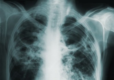 Pulmonary tuberculosis. Photo: CDC on Unsplash