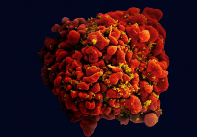 Scanning electron micrograph of an HIV-infected H9 T-cell. Credit: NIAID