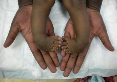 an image of babys feet and legs with clubfoot, being held in a pair of hands on a medical bed