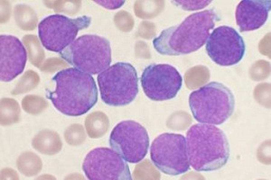 A Wright&#039;s stained bone marrow aspirate smear of patient with precursor B-cell acute lymphoblastic leukemia
