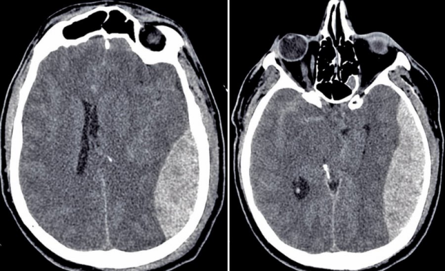 CT scan showing enlarging epidural