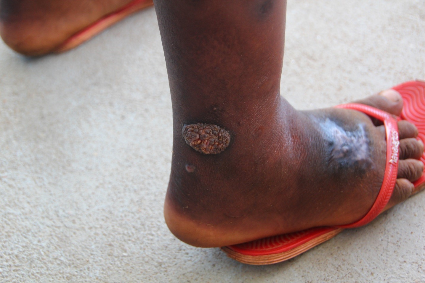 A yaws patient identified during case finding activities